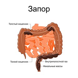Запор